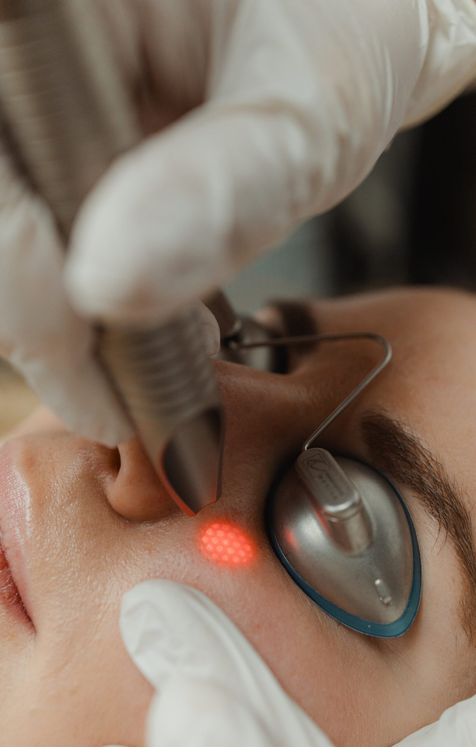 Fotona SmotheEye treatment